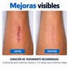 Cinta Eliminadora de Cicatrices y Queloides
